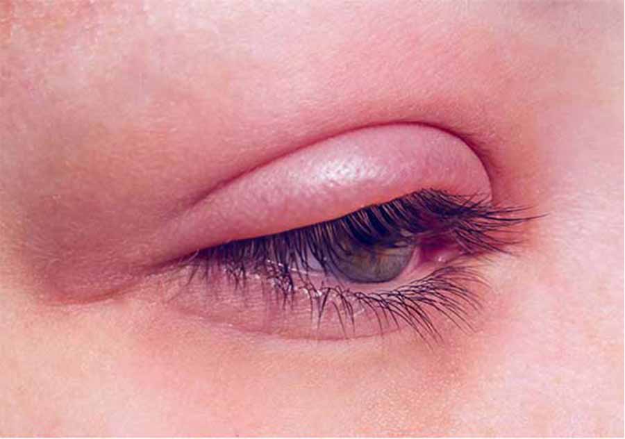 التهاب چشم از عوارض لیفت مژه