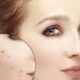 روش های خانگی برای درمان جوش صورت