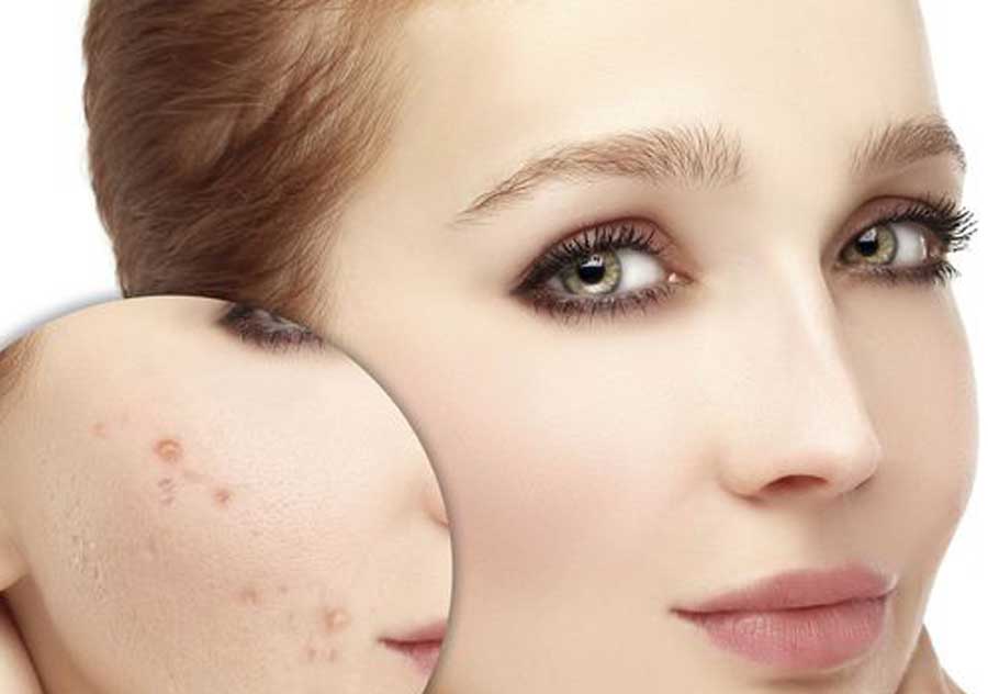 روش های خانگی برای درمان جوش صورت
