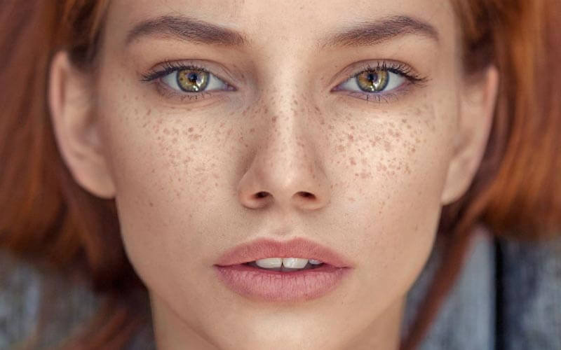 نکات مهم کاهش لک های پوستی و میلیا