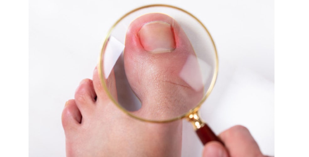 درمان فرورفتگی ناخن در گوشت پا